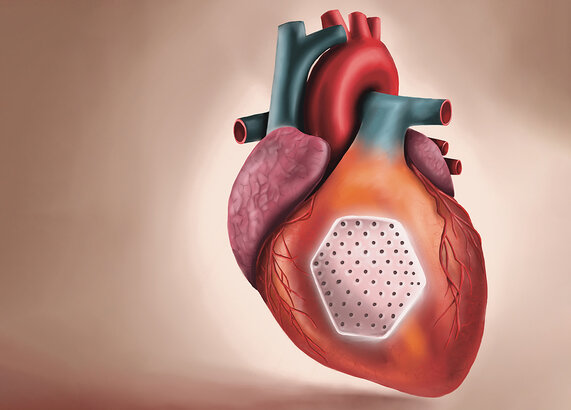Picture for press release "New Hope for Severe Heart Failure: Heart Patch Shows Clinical Efficacy"