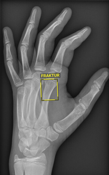 Presse-Information "Digitaler Kopilot in der Röntgenbildauswertung", Röntgenaufnahme Fraktur Mittelhandknochen