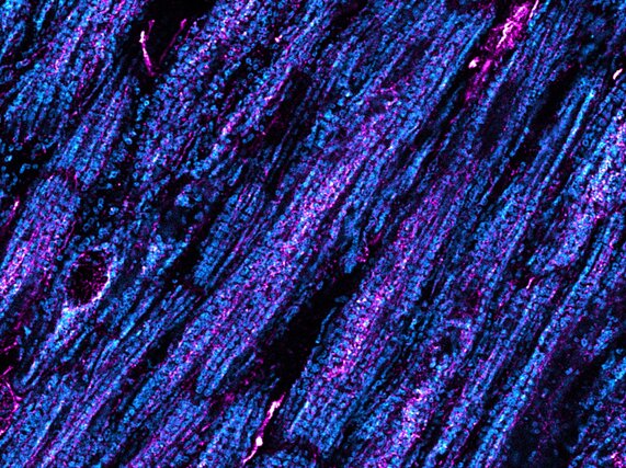 Bild zur Presseinformation "Vorhofflimmern: Gestörte Kalzium-Kommunikation bringt das Herz aus dem Takt"