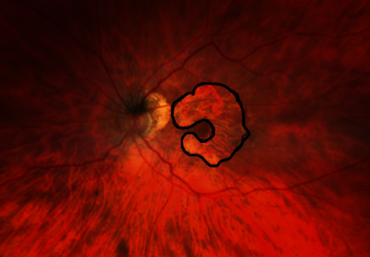 Bild zur Presse-News "Patient*innen-Aktionstag an der UMG zur altersbedingten Makuladegeneration"