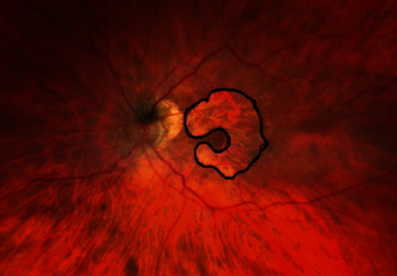 Bild zur Presse-News "Patient*innen-Aktionstag an der UMG zur altersbedingten Makuladegeneration"